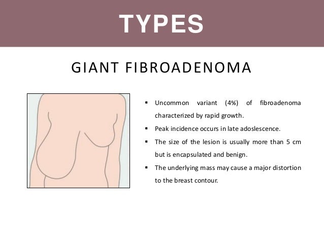 malignant breast diseases Ladies man missionary position